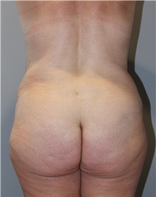 Tummy Tuck After Photo by Ellen Mahony, MD; Westport, CT - Case 46179