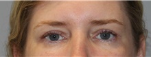 Eyelid Surgery After Photo by Ellen Mahony, MD; Westport, CT - Case 46181