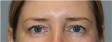 Eyelid Surgery Before Photo by Ellen Mahony, MD; Westport, CT - Case 46181