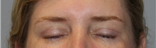 Eyelid Surgery After Photo by Ellen Mahony, MD; Westport, CT - Case 46181