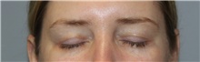 Eyelid Surgery Before Photo by Ellen Mahony, MD; Westport, CT - Case 46181