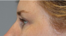 Eyelid Surgery After Photo by Ellen Mahony, MD; Westport, CT - Case 46181