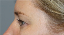 Eyelid Surgery Before Photo by Ellen Mahony, MD; Westport, CT - Case 46181