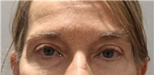 Eyelid Surgery After Photo by Ellen Mahony, MD; Westport, CT - Case 46350