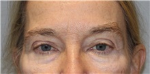 Eyelid Surgery Before Photo by Ellen Mahony, MD; Westport, CT - Case 46350