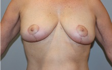 Breast Lift After Photo by Ellen Mahony, MD; Westport, CT - Case 46351