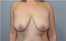 Breast Lift Before Photo by Ellen Mahony, MD; Westport, CT - Case 46351