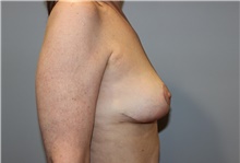 Breast Lift After Photo by Ellen Mahony, MD; Westport, CT - Case 46351