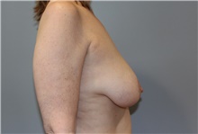 Breast Lift Before Photo by Ellen Mahony, MD; Westport, CT - Case 46351