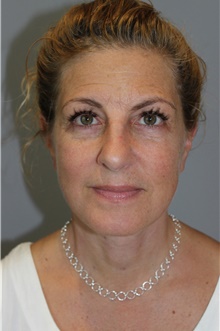 Facelift After Photo by Ellen Mahony, MD; Westport, CT - Case 46404