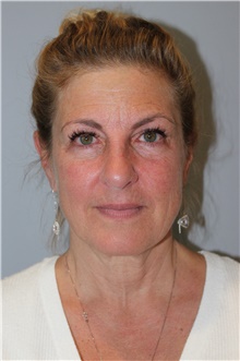 Facelift Before Photo by Ellen Mahony, MD; Westport, CT - Case 46404