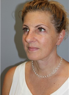 Facelift After Photo by Ellen Mahony, MD; Westport, CT - Case 46404