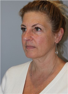 Facelift Before Photo by Ellen Mahony, MD; Westport, CT - Case 46404