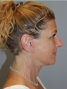 Facelift After Photo by Ellen Mahony, MD; Westport, CT - Case 46404