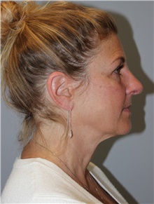 Facelift Before Photo by Ellen Mahony, MD; Westport, CT - Case 46404