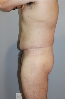 Body Lift After Photo by Ellen Mahony, MD; Westport, CT - Case 46405