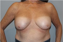 Breast Implant Revision After Photo by Ellen Mahony, MD; Westport, CT - Case 46440 Breast Implant Revision After Photo by Ellen Mahony, MD; Westport, CT - Case 46440
