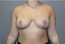 Breast Reduction After Photo by Ellen Mahony, MD; Westport, CT - Case 46442