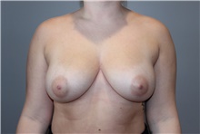 Breast Reduction Before Photo by Ellen Mahony, MD; Westport, CT - Case 46442