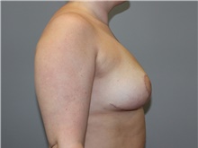 Breast Reduction After Photo by Ellen Mahony, MD; Westport, CT - Case 46442