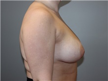 Breast Reduction Before Photo by Ellen Mahony, MD; Westport, CT - Case 46442