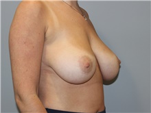 Breast Reduction Before Photo by Ellen Mahony, MD; Westport, CT - Case 46589