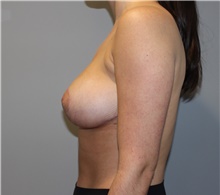 Breast Reduction After Photo by Ellen Mahony, MD; Westport, CT - Case 46589