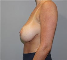 Breast Reduction Before Photo by Ellen Mahony, MD; Westport, CT - Case 46589