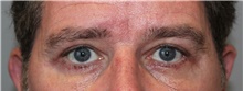 Eyelid Surgery After Photo by Ellen Mahony, MD; Westport, CT - Case 46696