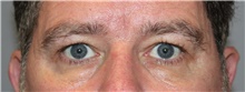 Eyelid Surgery Before Photo by Ellen Mahony, MD; Westport, CT - Case 46696