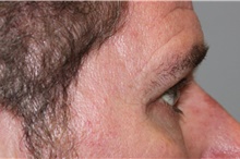 Eyelid Surgery After Photo by Ellen Mahony, MD; Westport, CT - Case 46696