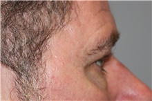 Eyelid Surgery Before Photo by Ellen Mahony, MD; Westport, CT - Case 46696