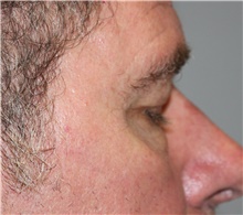 Eyelid Surgery Before Photo by Ellen Mahony, MD; Westport, CT - Case 46696