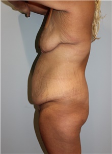 Mommy Makeover Before Photo by Ellen Mahony, MD; Westport, CT - Case 46935
