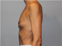 Breast Augmentation Before Photo by Ellen Mahony, MD; Westport, CT - Case 46937