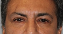 Eyelid Surgery After Photo by Ellen Mahony, MD; Westport, CT - Case 47052