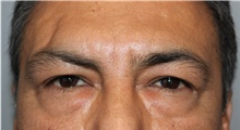 Eyelid Surgery Before Photo by Ellen Mahony, MD; Westport, CT - Case 47052