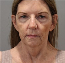 Facelift Before Photo by Ellen Mahony, MD; Westport, CT - Case 47186