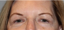 Eyelid Surgery After Photo by Ellen Mahony, MD; Westport, CT - Case 47187