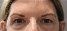 Eyelid Surgery Before Photo by Ellen Mahony, MD; Westport, CT - Case 47187