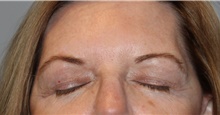 Eyelid Surgery After Photo by Ellen Mahony, MD; Westport, CT - Case 47187