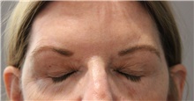 Eyelid Surgery Before Photo by Ellen Mahony, MD; Westport, CT - Case 47187