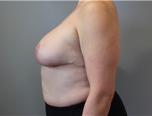 Breast Reduction After Photo by Ellen Mahony, MD; Westport, CT - Case 47195