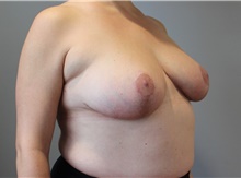 Breast Reduction After Photo by Ellen Mahony, MD; Westport, CT - Case 47195