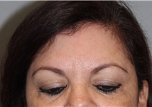 Botulinum Toxin After Photo by Ellen Mahony, MD; Westport, CT - Case 47650