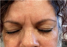 Botulinum Toxin Before Photo by Ellen Mahony, MD; Westport, CT - Case 47650