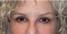 Eyelid Surgery After Photo by Ellen Mahony, MD; Westport, CT - Case 47755