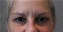 Eyelid Surgery Before Photo by Ellen Mahony, MD; Westport, CT - Case 47755