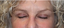 Eyelid Surgery After Photo by Ellen Mahony, MD; Westport, CT - Case 47755