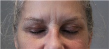 Eyelid Surgery Before Photo by Ellen Mahony, MD; Westport, CT - Case 47755